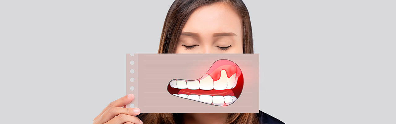 лечение гингивита